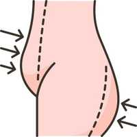 Подтяжка тела (торсопластика)